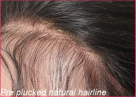 natural hairline